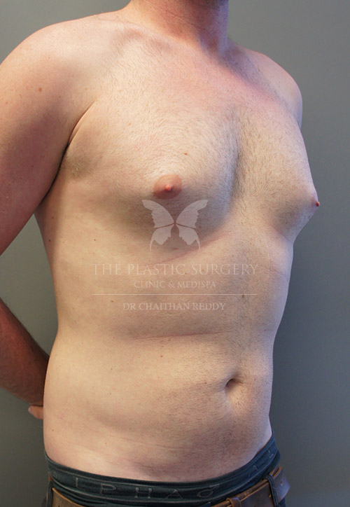 PatientGynaecomastia 3a Pre - The Plastic Surgery Clinic