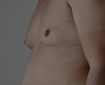 gynaecomastia - male breast reduction in Sydney