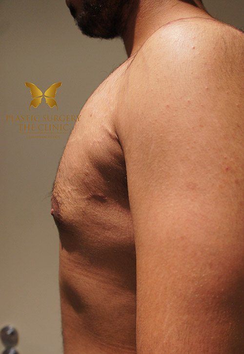 After Gynecomastia