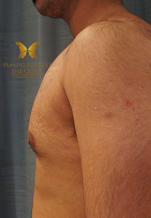 Gynaecomastia Before 1 | Male Breast Reduction | The Plastic Surgery Clinic Sydney