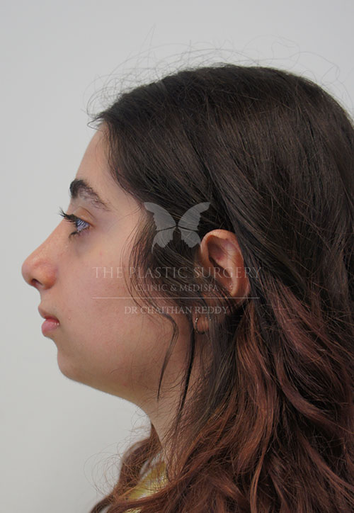 rhinoplasty surgery before and after photos - image 001d - after