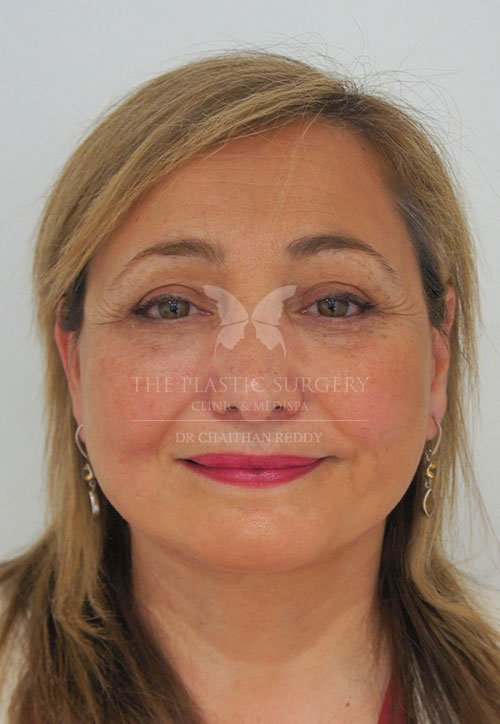 rhinoplasty before and after - image 003a - after