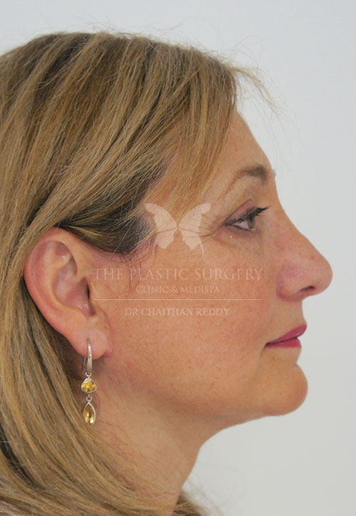 rhinoplasty before and after - image 003c - after surgery - real patient's photo