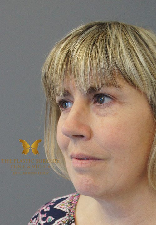 before and after - facelift & neck lift - image 011 - after