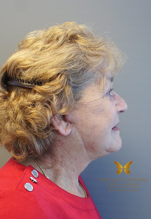 before and after - facelift and neck surgery - image 014 - after