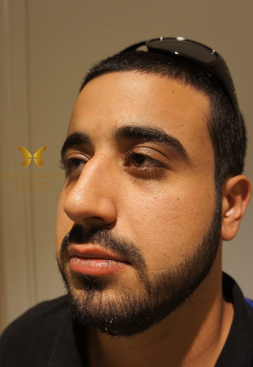 nose job surgery before and after - image 007 - before rhinoplasty