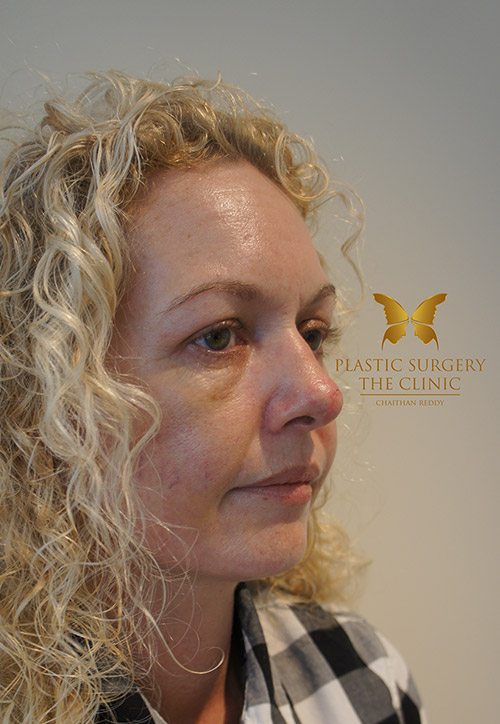 rhinoplasty - nose surgery before and after - image 009 - before