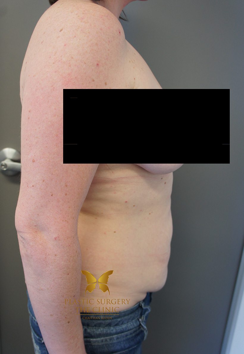 Patient 2 Before 03 | Abdominoplasty (Tummy Tuck) Before and Afters | The Plastic Surgery Clinic | Sydney