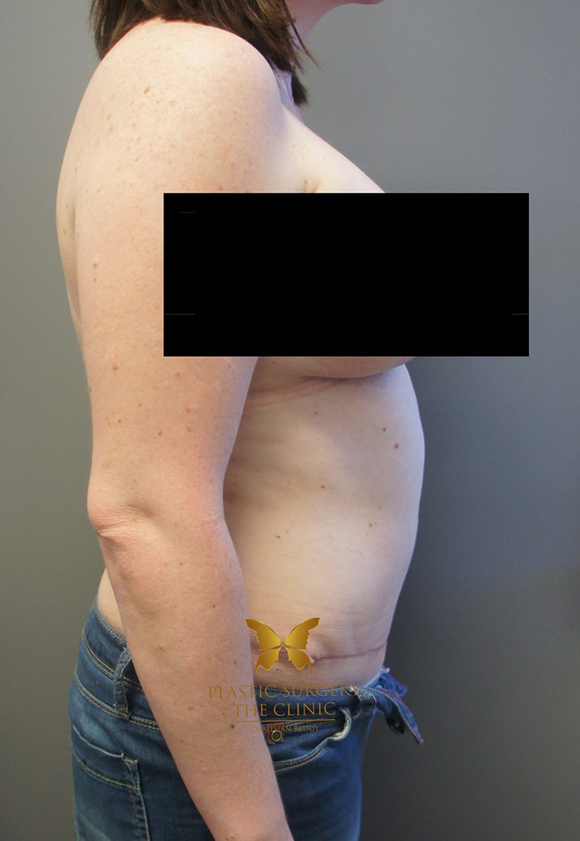 Patient 2 After 03 | Abdominoplasty (Tummy Tuck) Before and Afters | The Plastic Surgery Clinic | Sydney