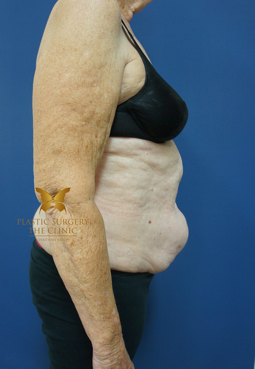 Patient 3 Before 03 | Abdominoplasty (Tummy Tuck) Before and Afters | The Plastic Surgery Clinic | Sydney