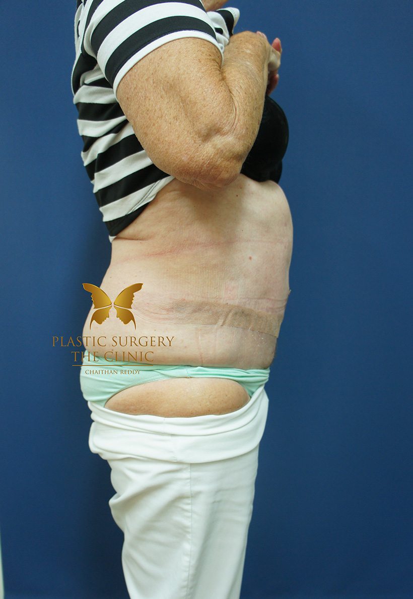 Patient 3 After 03 | Abdominoplasty (Tummy Tuck) Before and Afters | The Plastic Surgery Clinic | Sydney