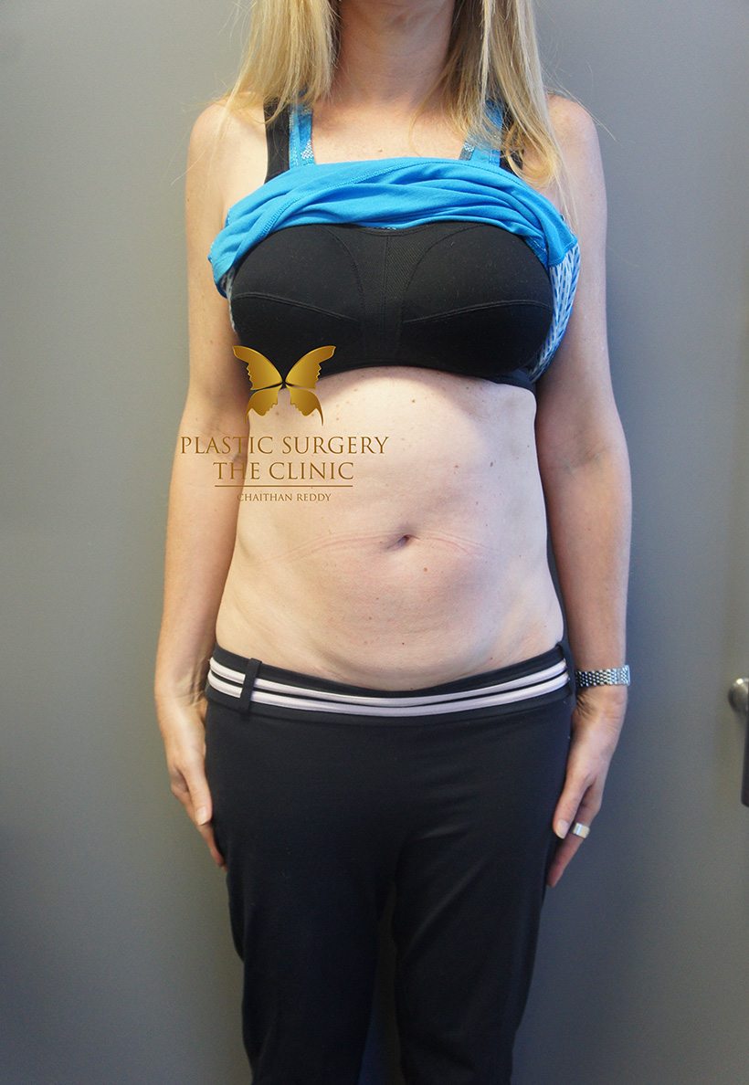 Patient 5 Before | Abdominoplasty (Tummy Tuck) Before and Afters | The Plastic Surgery Clinic | Sydney
