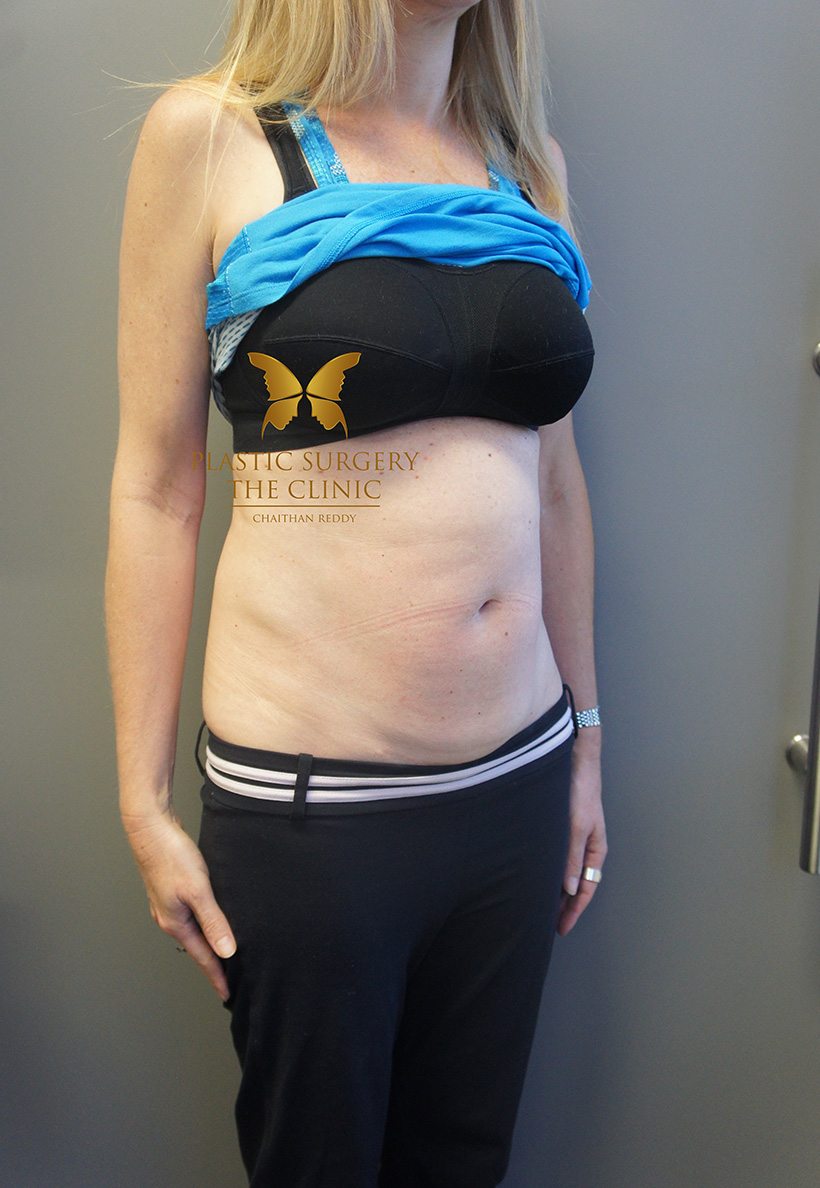 Patient 5 Before 02 | Abdominoplasty (Tummy Tuck) Before and Afters | The Plastic Surgery Clinic | Sydney