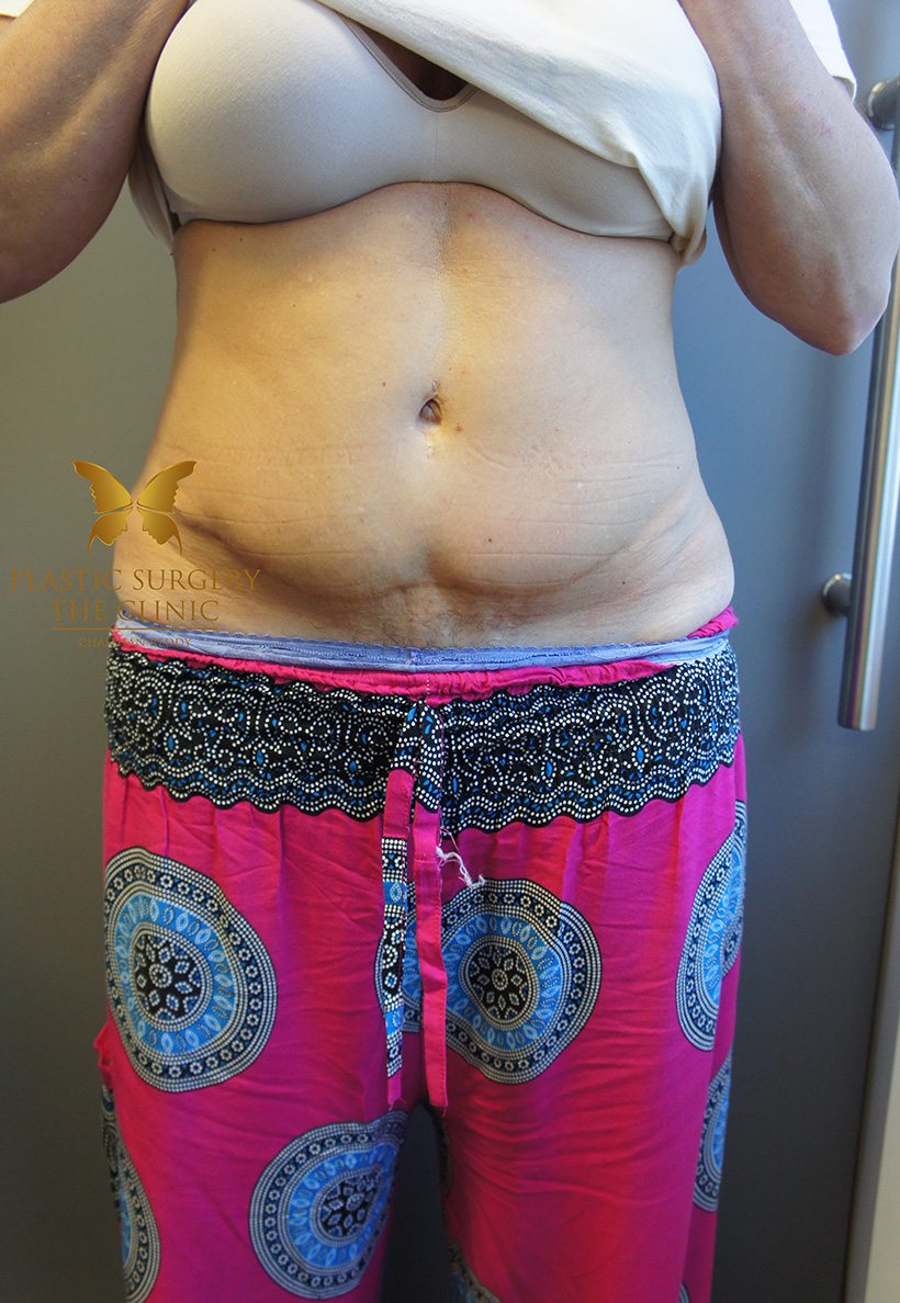 Patient 7 Before | Abdominoplasty (Tummy Tuck) Before and Afters | The Plastic Surgery Clinic | Sydney