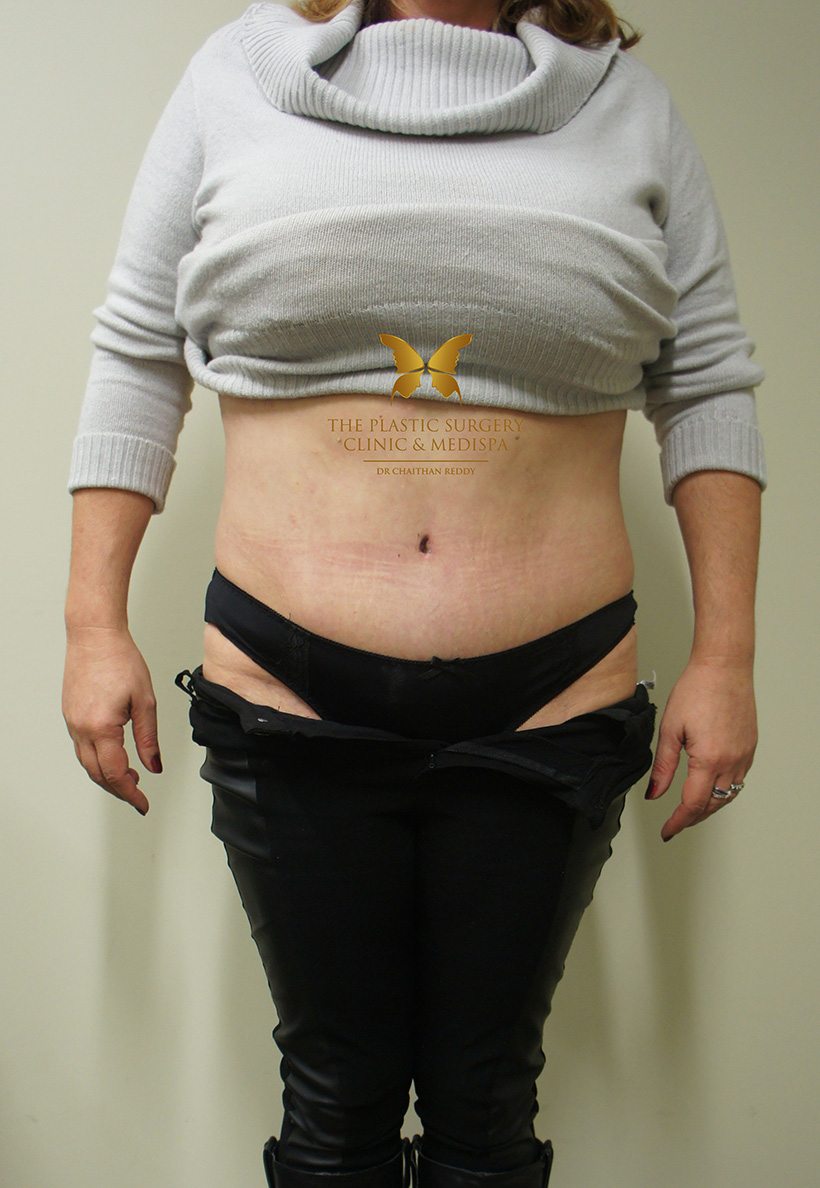 Patient 8 After | Abdominoplasty (Tummy Tuck) Before and Afters | The Plastic Surgery Clinic | Sydney