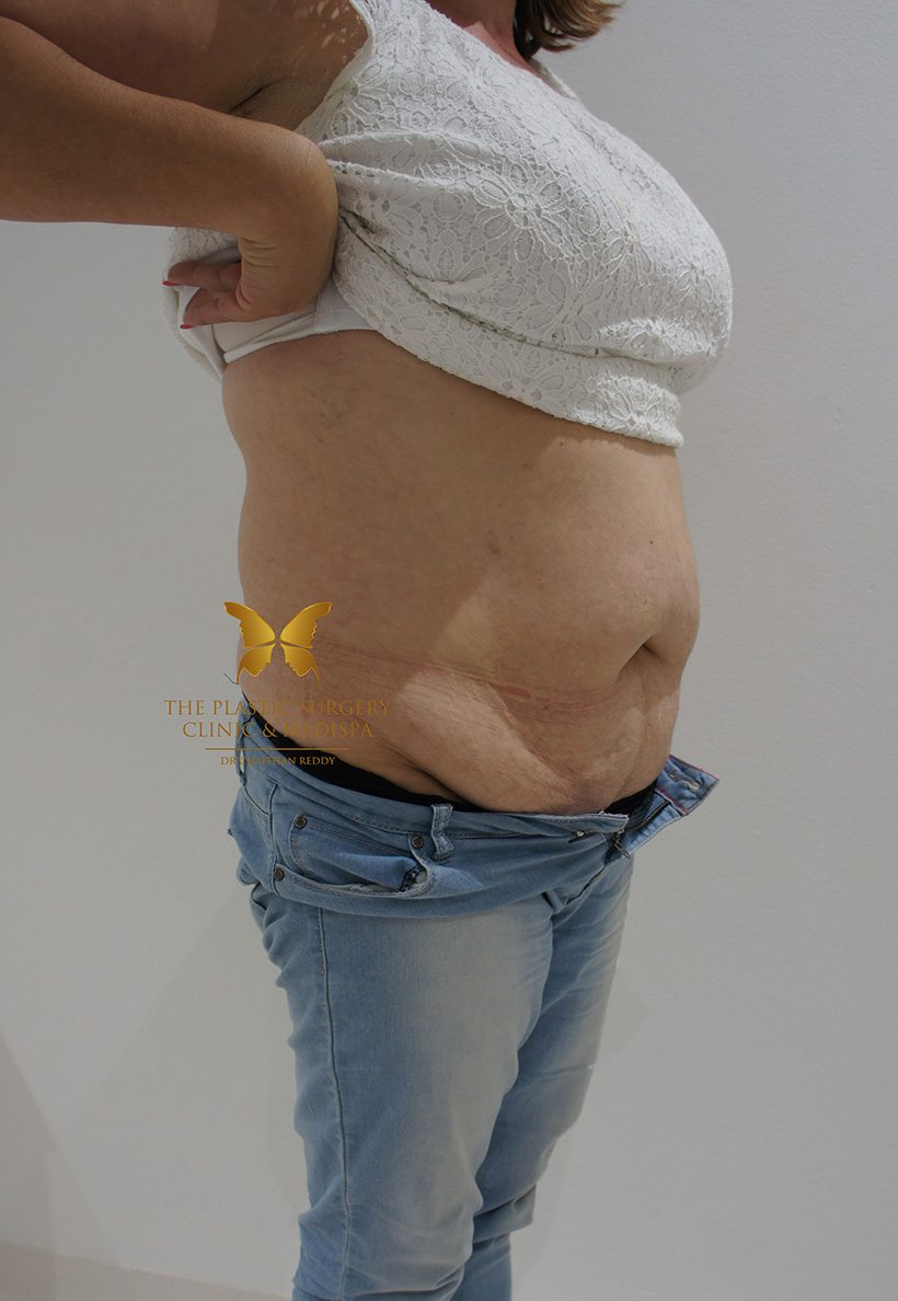 Patient 8 Before 02 | Abdominoplasty (Tummy Tuck) Before and Afters | The Plastic Surgery Clinic | Sydney