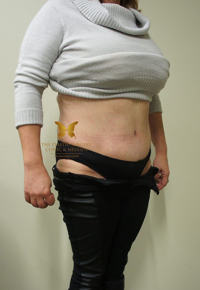 Patient 8 After 02 | Abdominoplasty (Tummy Tuck) Before and Afters | The Plastic Surgery Clinic | Sydney