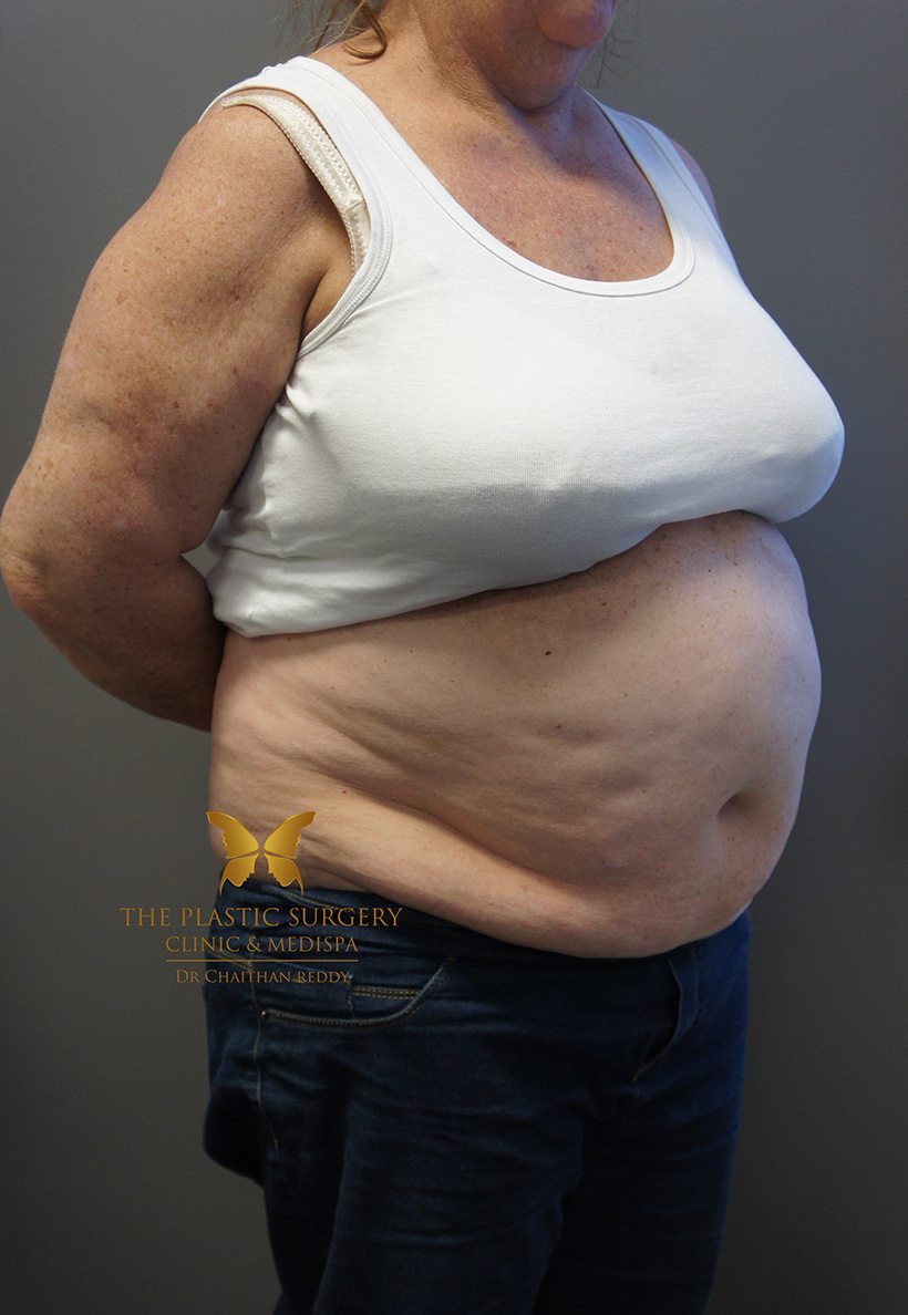 Patient 9 before 02 | Abdominoplasty (Tummy Tuck) Before and Afters | The Plastic Surgery Clinic | Sydney