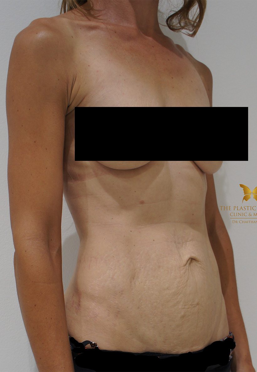 Patient 6 Before | Mummy Makeover Before and Afters | The Plastic Surgery Clinic | Sydney