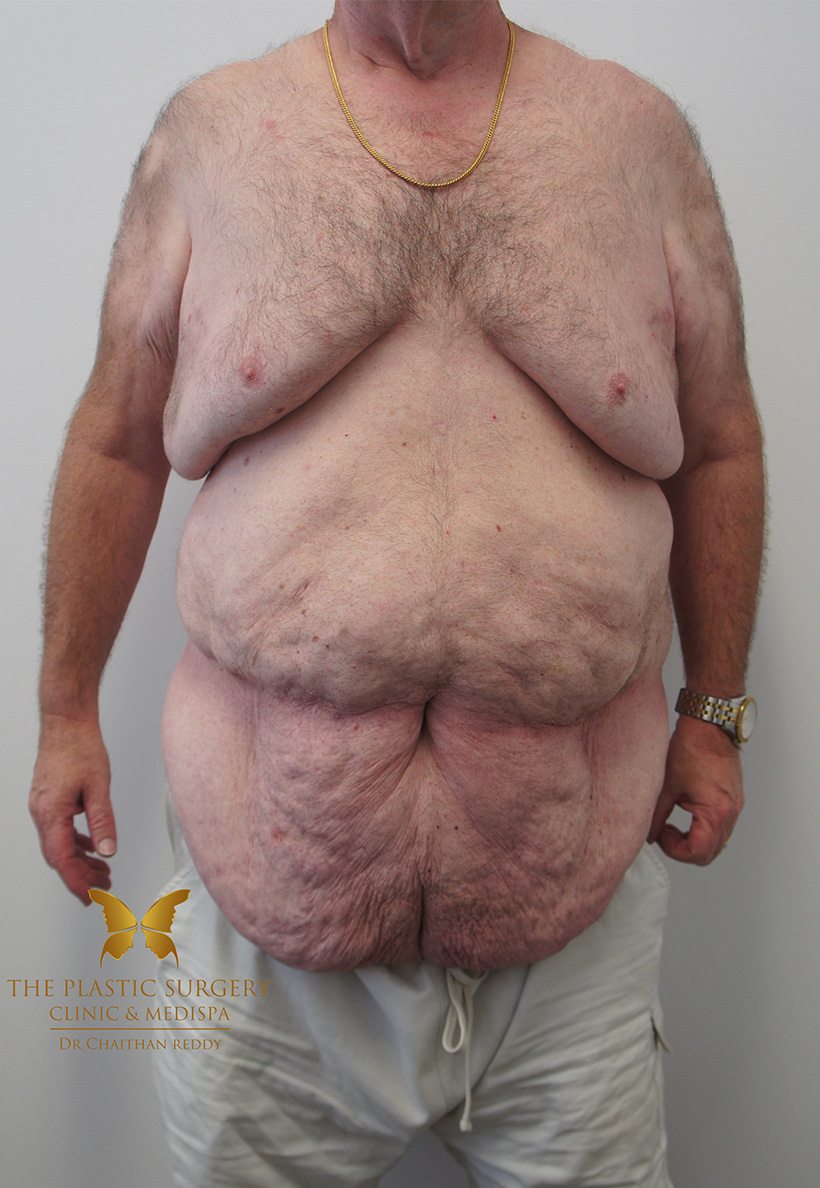 Patient 12 Before | Abdominoplasty (Tummy Tuck) Before and Afters | The Plastic Surgery Clinic | Sydney