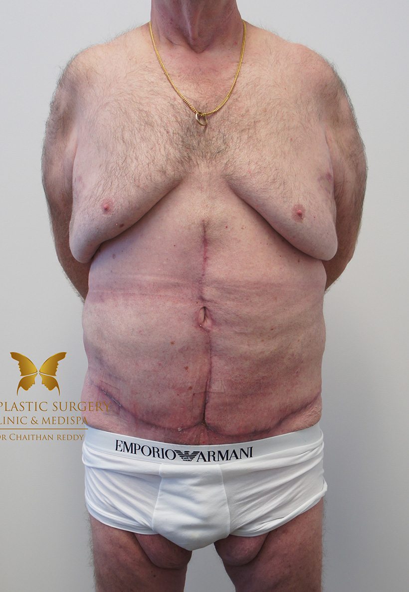 Patient 12 After | Abdominoplasty (Tummy Tuck) Before and Afters | The Plastic Surgery Clinic | Sydney