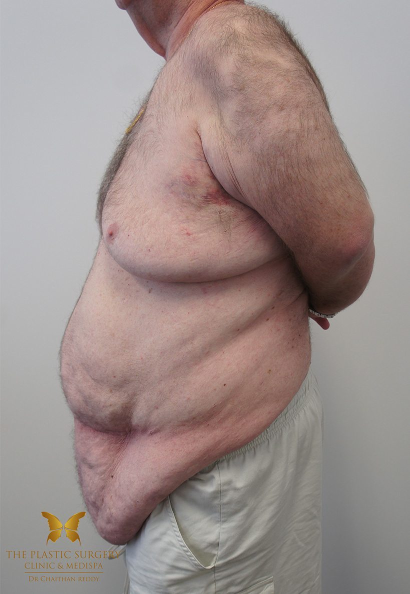 Patient 12 Before 03 | Abdominoplasty (Tummy Tuck) Before and Afters | The Plastic Surgery Clinic | Sydney