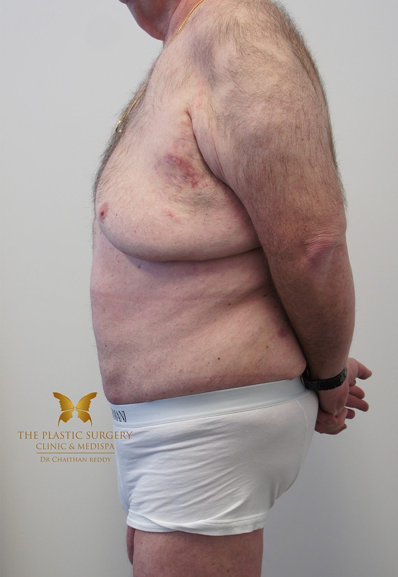 Patient 12 After 03 | Abdominoplasty (Tummy Tuck) Before and Afters | The Plastic Surgery Clinic | Sydney