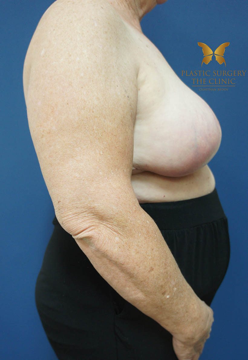 after breast reduction