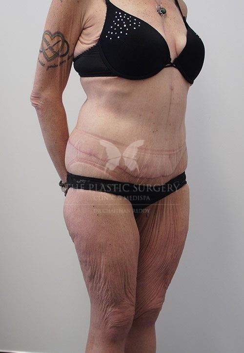 The Plastic Surgery Clinic - Abdominoplasty Before and After - 89 After