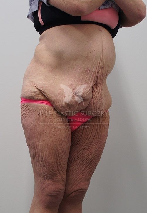 The Plastic Surgery Clinic - Abdominoplasty Before and After - 89 Before