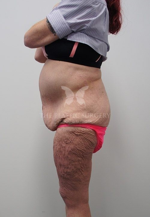 The Plastic Surgery Clinic - Abdominoplasty Before and After - 90 Before