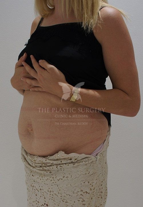 The Plastic Surgery Clinic - Abdominoplasty Before and After - 91 Before