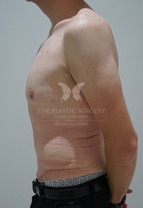 The Plastic Surgery Clinic - Abdominoplasty Before and After - 95 After