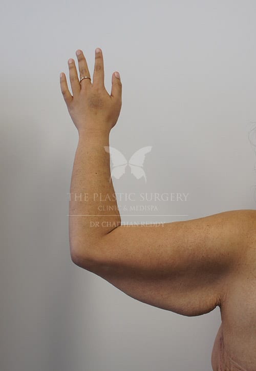 arm lift before and after photos - image 001a - before