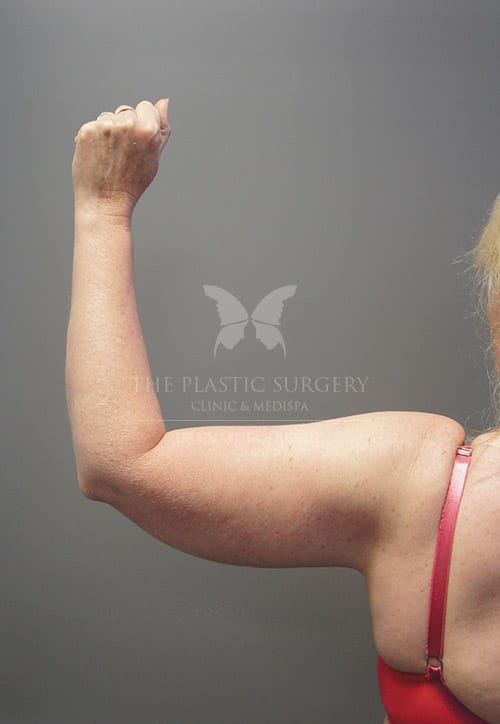 brachioplasty surgery before and after - image 003a - before