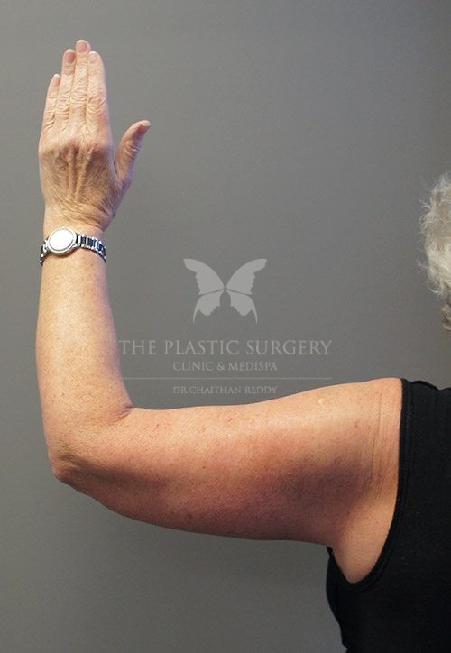 arm lift surgery before and after - image 001 - after