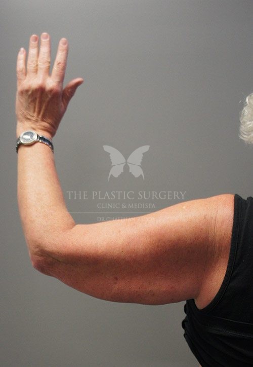 arm lift surgery before and after - image 001 - before