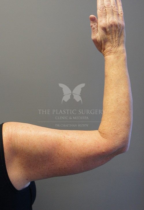 arm lift surgery before and after - image 002 - after