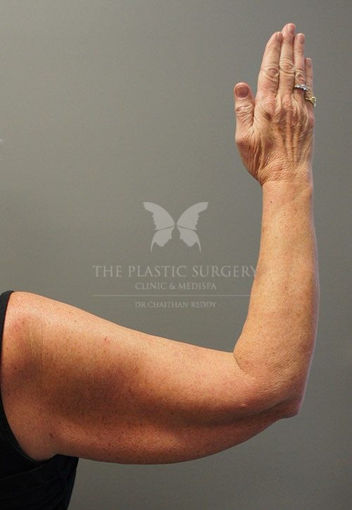 arm lift surgery before and after - image 002 - before