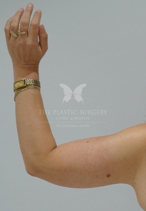 arm lift surgery before and after - image 003 - after