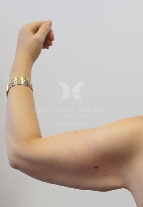 arm lift surgery before and after - image 003 - before