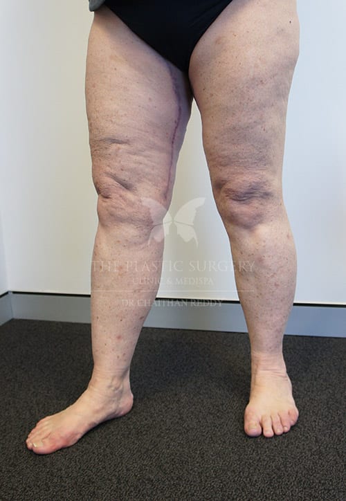 thigh lift surgery - image 002a - after
