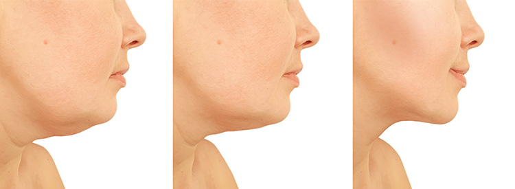 Neck Lift Lipo