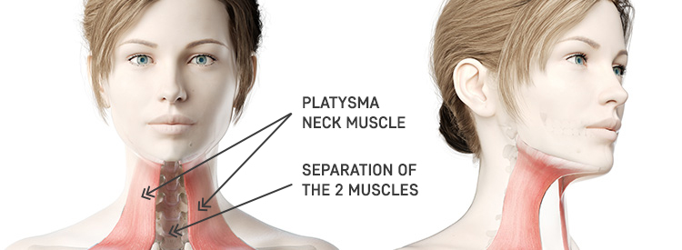 Neck Lift