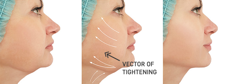 Neck Lift