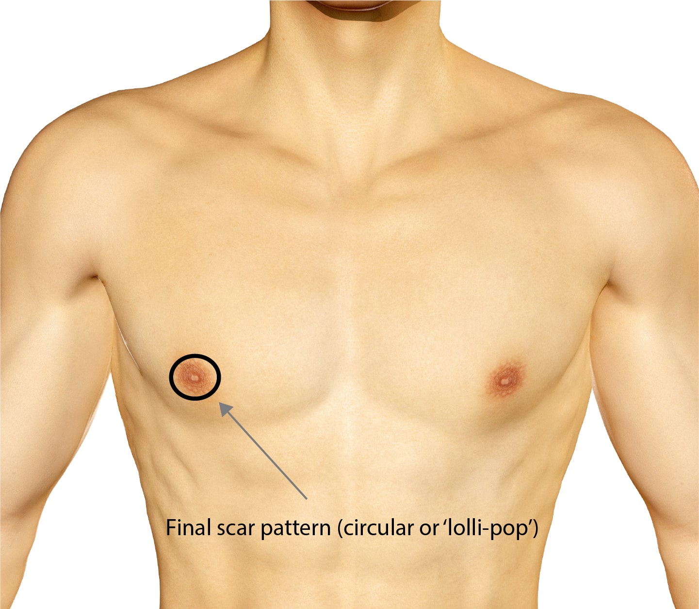 Top Surgery, approach 2 (Peri-areolar incision), photo 03, Dr Reddy